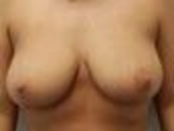 Breast Augmentation w/ Lift: Case 672 - Before