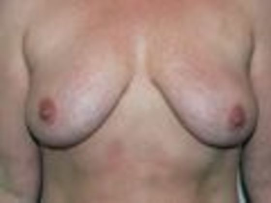 Breast Augmentation w/ Lift: Case 58 - Before