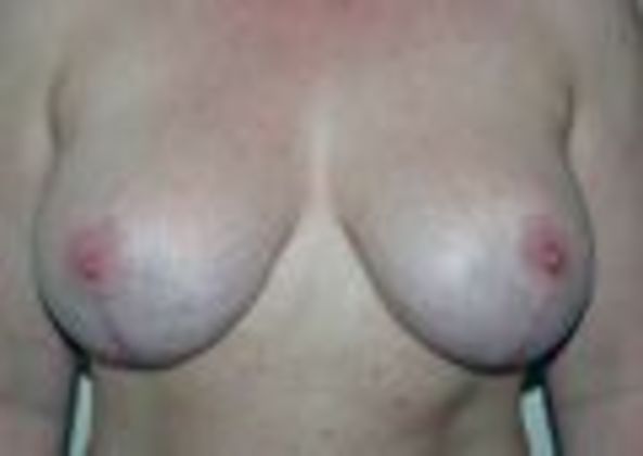Breast Augmentation w/ Lift: Case 58 - After