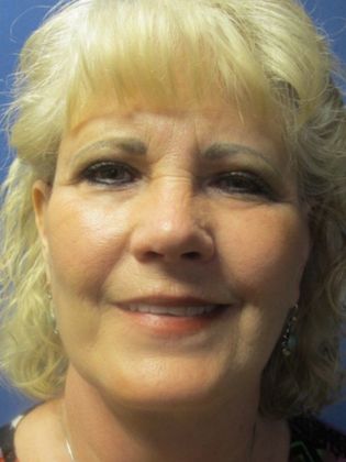 Facelift / RestoreLift: Case 13 - After