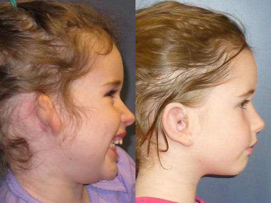 Other Microtia Photos Cases