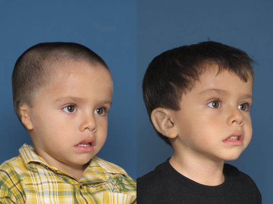 Other Microtia Photos Case 12