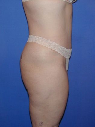 Abdominoplasty - Tummy Tuck Case 25 - After