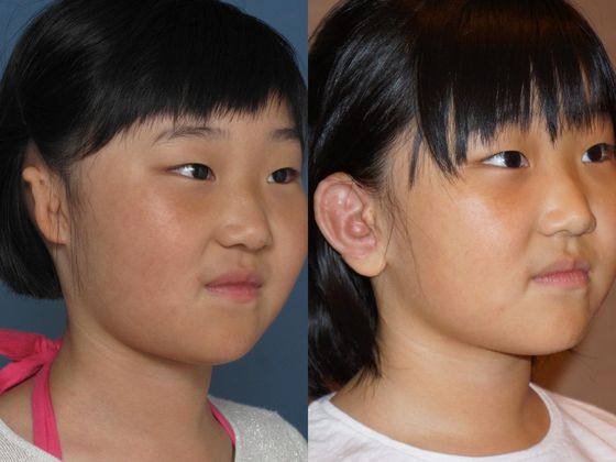 Other Microtia Photos Case 17