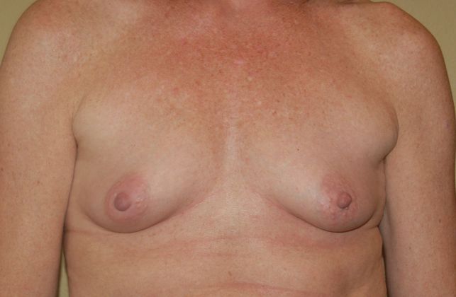 Breast Augmentation w/ Lift Case 99 - Before