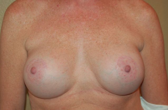 Breast Augmentation w/ Lift Case 99 - After