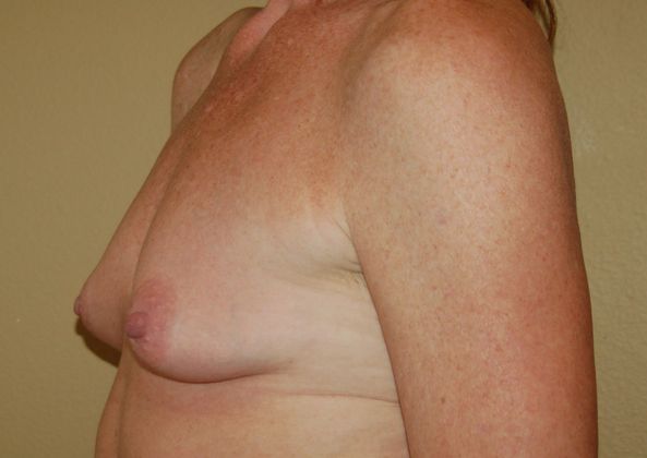Breast Augmentation w/ Lift: Case 625 - Before