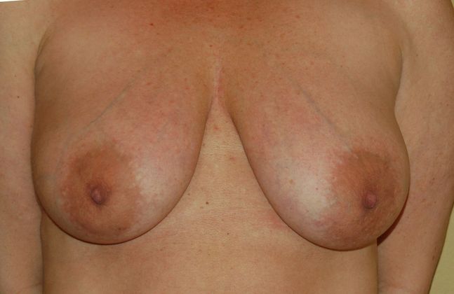 Breast Lift (Mastopexy) Case 18 - Before