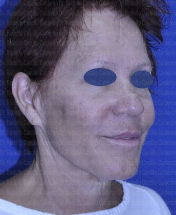 Face & Neck Lifts: Face and Neck Lift - Before facelift and neck lift oblique view