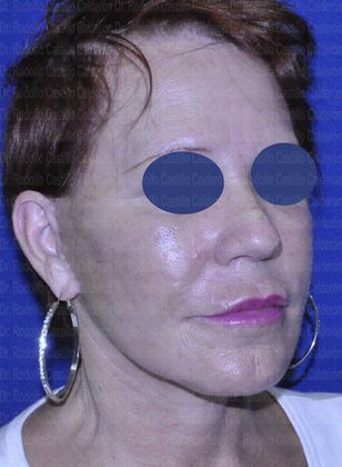 Face & Neck Lifts: Face and Neck Lift - after facelift and neck lift oblique view