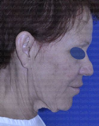 Face & Neck Lifts: Face and Neck Lift - before facelift and neck lift lateral view looking down