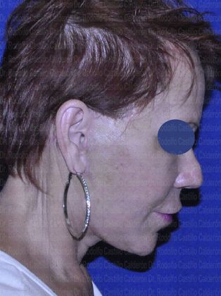 Face & Neck Lifts: Face and Neck Lift - after facelift and neck lift lateral view looking down