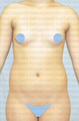 Liposuction Patient with liposculpture and Breast Augmentation - Before