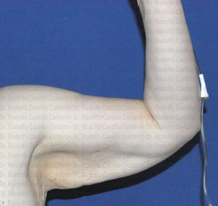 Post Bariatric Plastic Surgery Patient with extended Arm Lift - Before