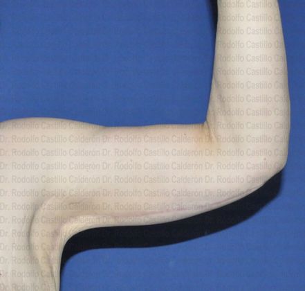 Post Bariatric Plastic Surgery Patient with extended Arm Lift - After