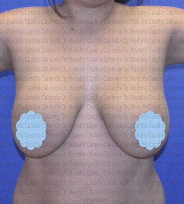 Breast Lift: Patient with revision breast surgery - Before breast lift with implants exchange frontal view