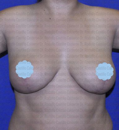 Breast Lift: Patient with revision breast surgery - After breast lift with implants exchange frontal view