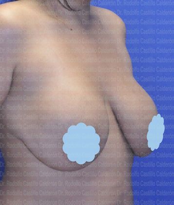Breast Lift: Patient with revision breast surgery - before breast lift with implants exchange oblique view
