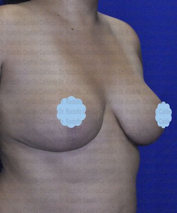 Breast Lift: Patient with revision breast surgery - After breast lift with implants exchange oblique view
