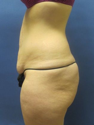 Abdominoplasty - Tummy Tuck: Case 28 - Before