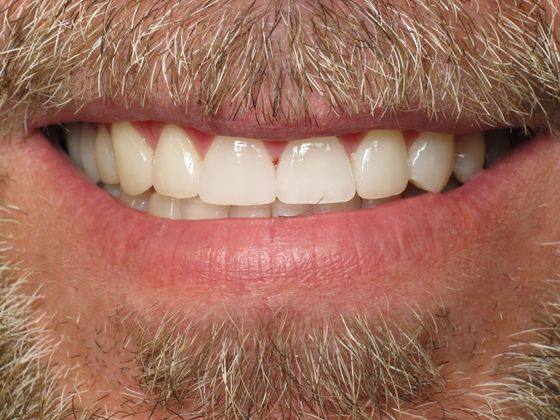 Smile Makeover Case 4 - After