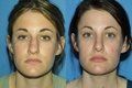 Rhinoplasty