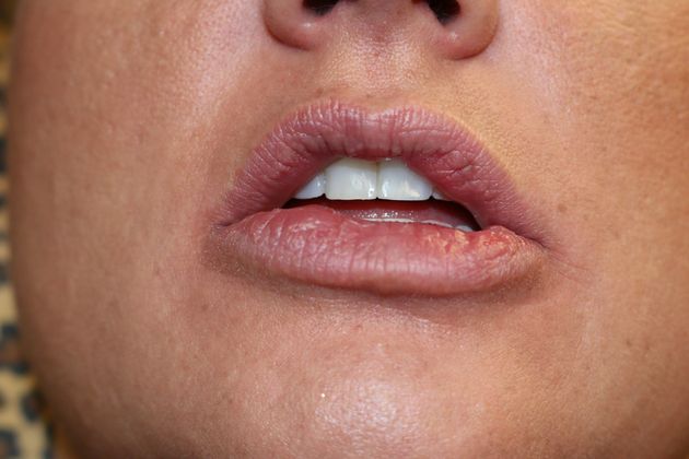 Cosmetic Injectables & Fillers*: Case 16 Lip Filler - Before correction of Juvederm