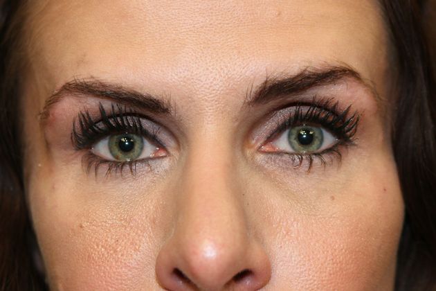 Cosmetic Injectables & Fillers*: Case 34 Undereye Filler - After Treatment to tear troughs.