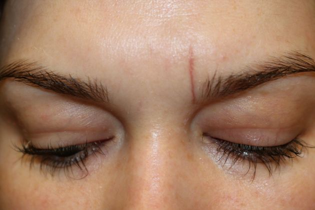 Laser Skin Resurfacing*: Scar Therapy - Before Laser Scar Therapy