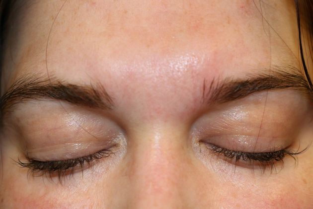 Laser Skin Resurfacing*: Scar Therapy - After 3 Treatments
