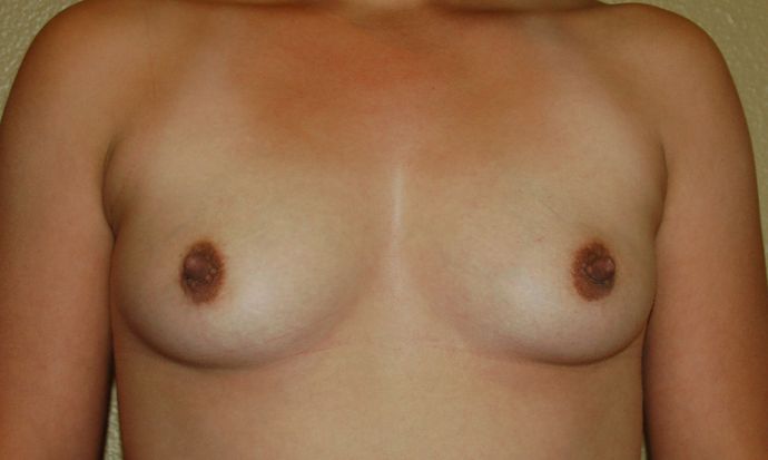 Breast Augmentation Case 231 - Before