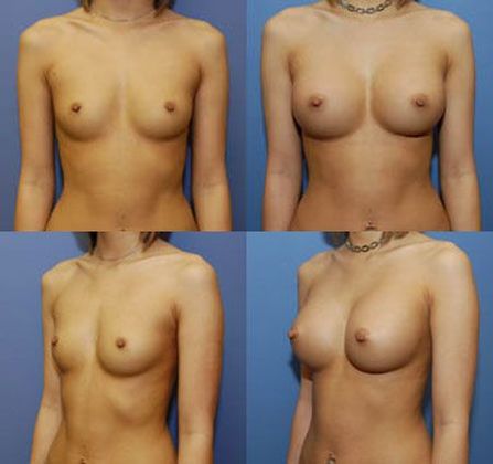 22 y/o female presented with A/B cup and asymmetry and desire to be approxi...