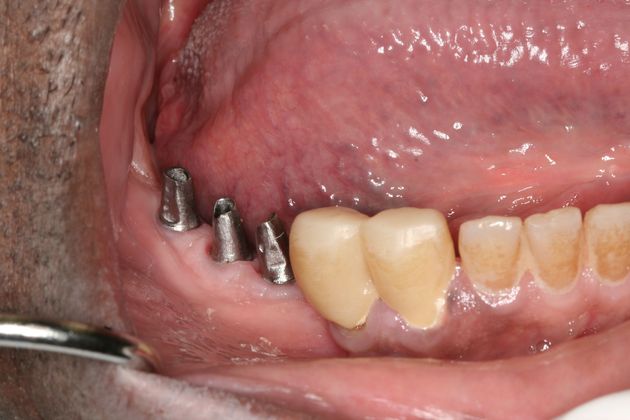 Dr. Malki's patient with unrestored dental implants