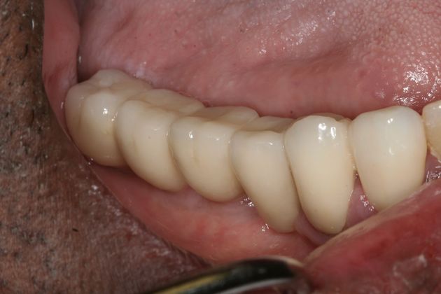 Dr. Malki's patient with restored implants