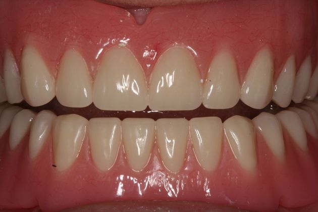 Dental Implants: Case 11 - Final dentures clipped into bars