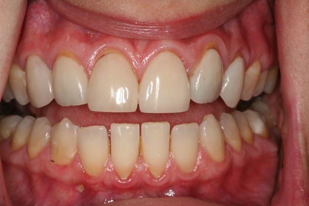 Veneers Case 7 - Before