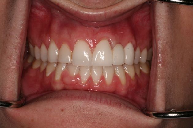 Bridges Case 2 - After