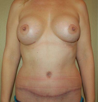 Mommy Makeover Case 39 - After