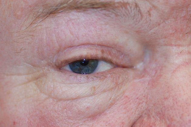 Facial Tumors and Growths Case 16 - After