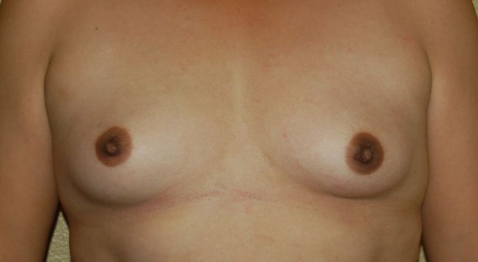 Breast Augmentation Case 234 - Before