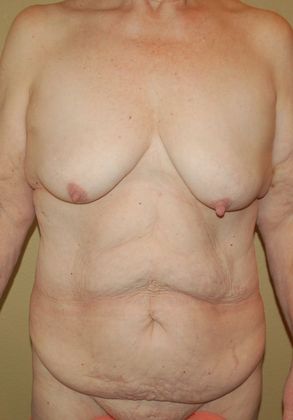 Massive Weight Loss : Case 20 - Before