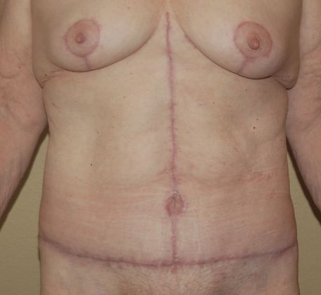 Massive Weight Loss : Case 20 - After