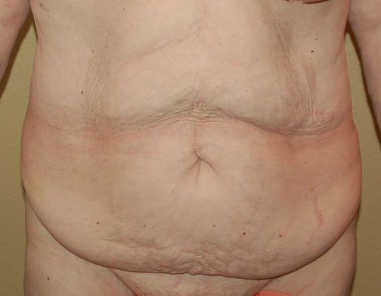 Massive Weight Loss : Case 20 - Before