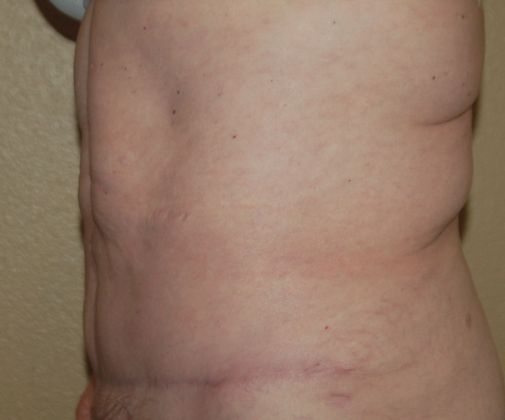 Massive Weight Loss : Case 20 - After