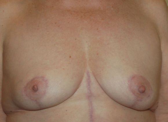 Massive Weight Loss : Case 20 - After