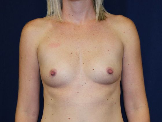 Breast Augmentation*: Case 34 - Before