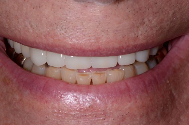 Dental Implants Case 8 - After