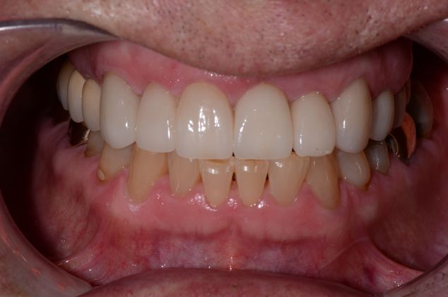 Dental Implants: Case 8 - After smile design
