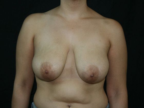 Breast Reduction*: Case 7 - Before