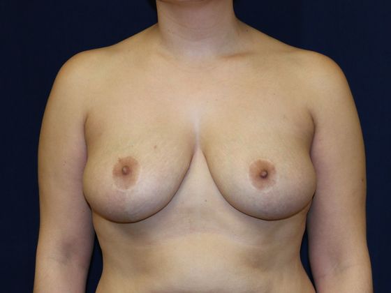Breast Reduction*: Case 7 - After